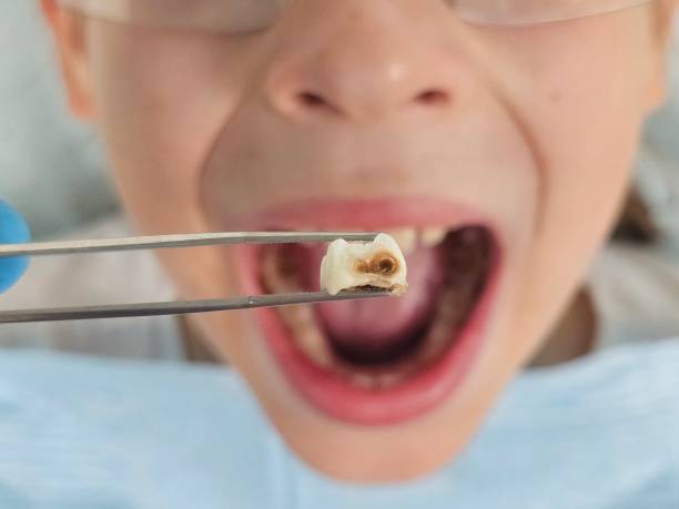 Best Emergency Dental Care for Broken or Chipped Teeth in Milton Freewater, OR